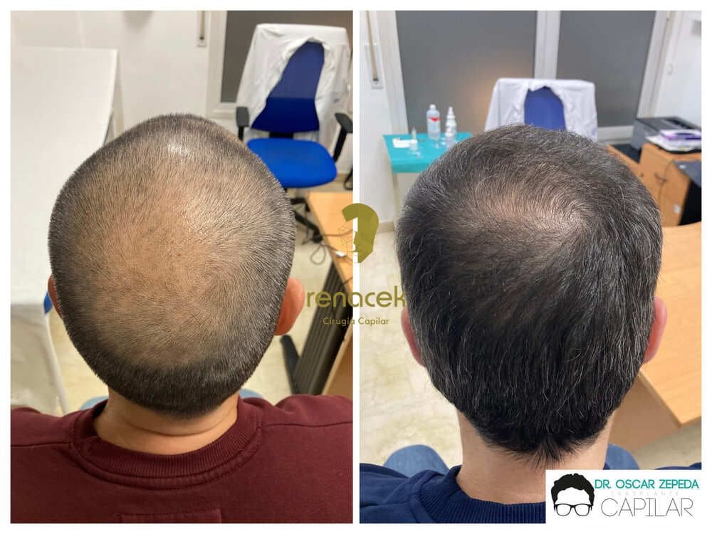 Antes y después de injerto capilar zaragoza