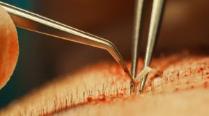 Beneficios del PRP Capilar