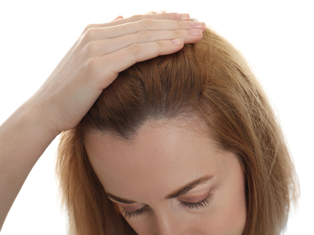Mujer apartándose el pelo para mostrar la raya aclarada en la parte superior de la cabeza
