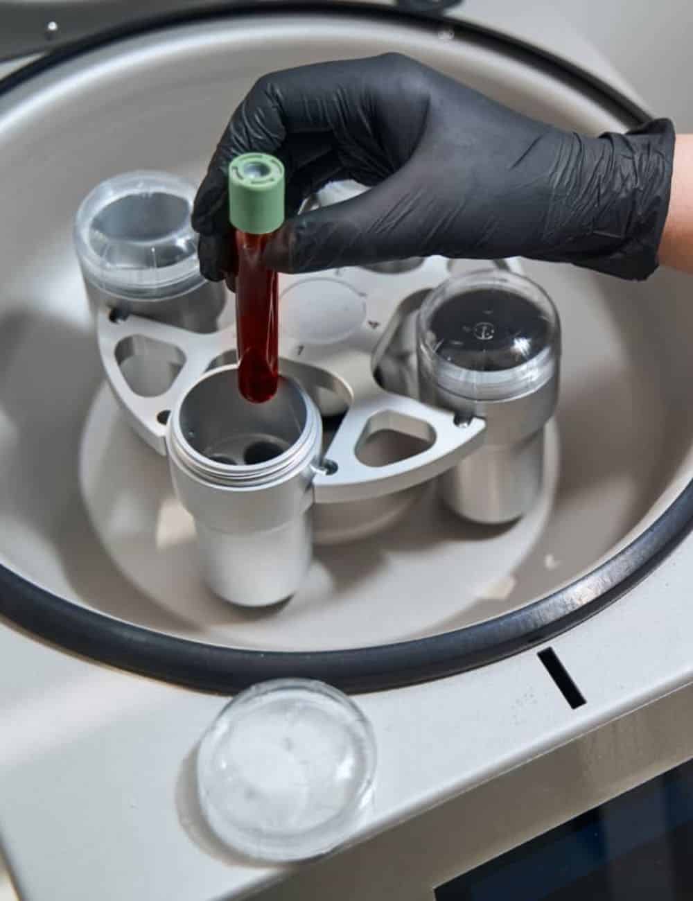 Tubo de sangre en la centrífuga para separar el plasma rico en plaquetas