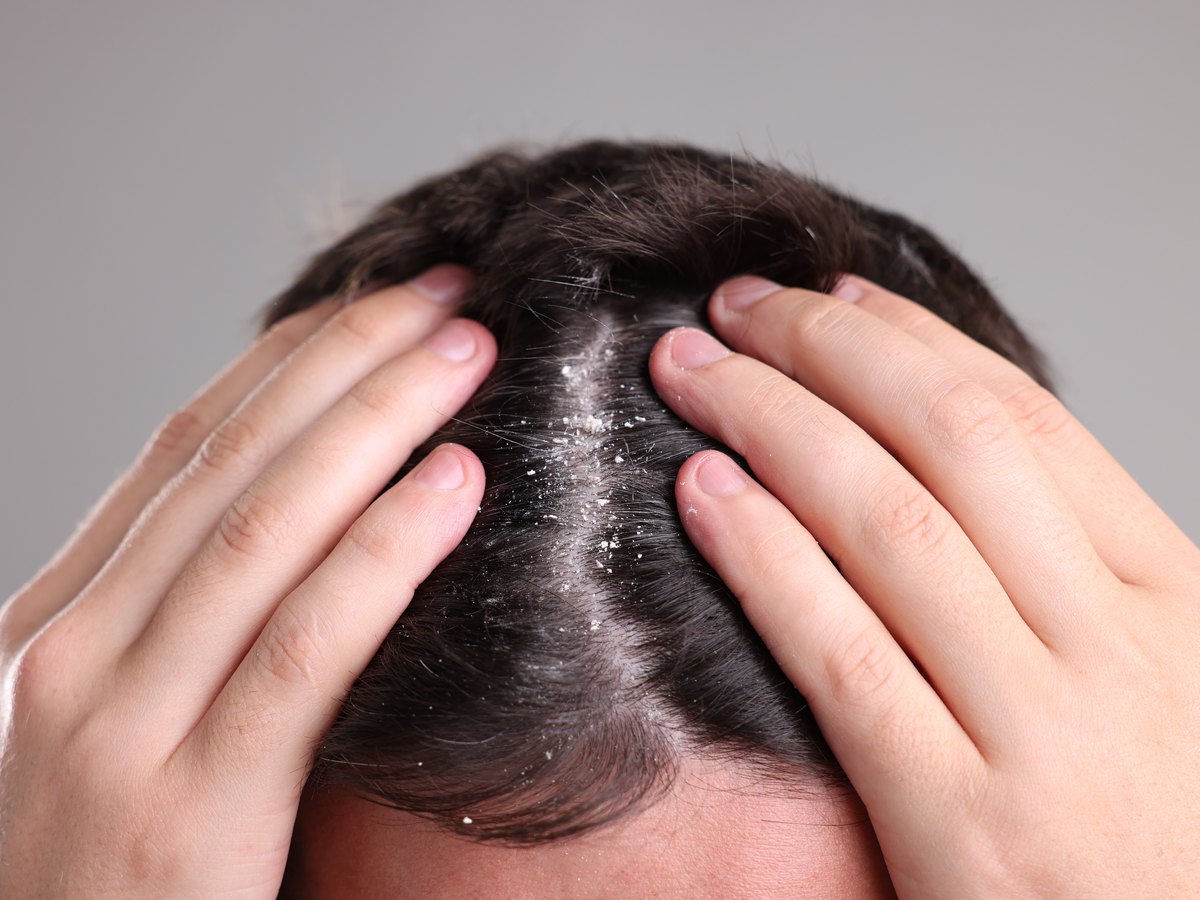 Hombre separándose el pelo con las manos y mostrando escamas en el cuero cabelludo
