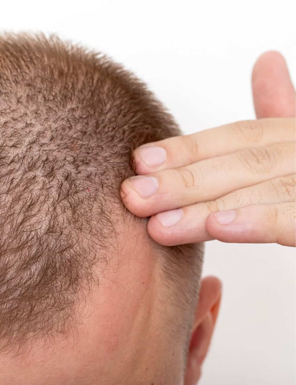 Hombre apartándose el pelo para mostrar las entradas