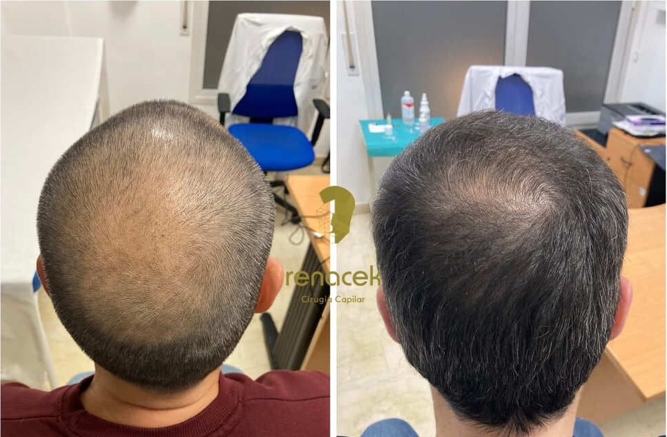 Antes y después de un injerto capilar en la coronilla, paciente de Renacek en Zaragoza