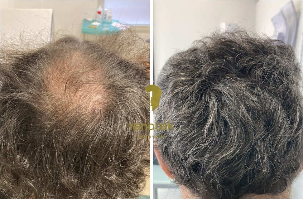 Antes y después de un injerto capilar en la coronilla con pelo rizado, paciente de Renacek en Zaragoza