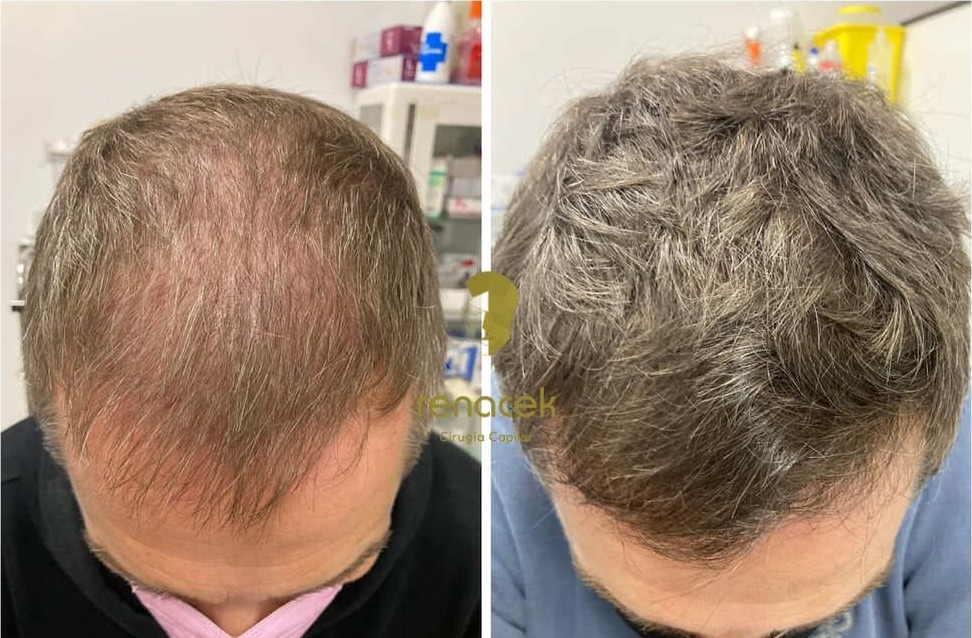 Antes y después de un injerto capilar en la zona frontal, paciente de Renacek en Zaragoza