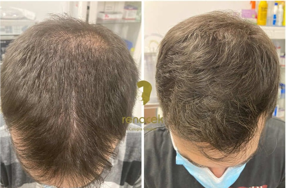 Antes y después de un injerto capilar en la zona superior de la cabeza, paciente de Renacek en Zaragoza