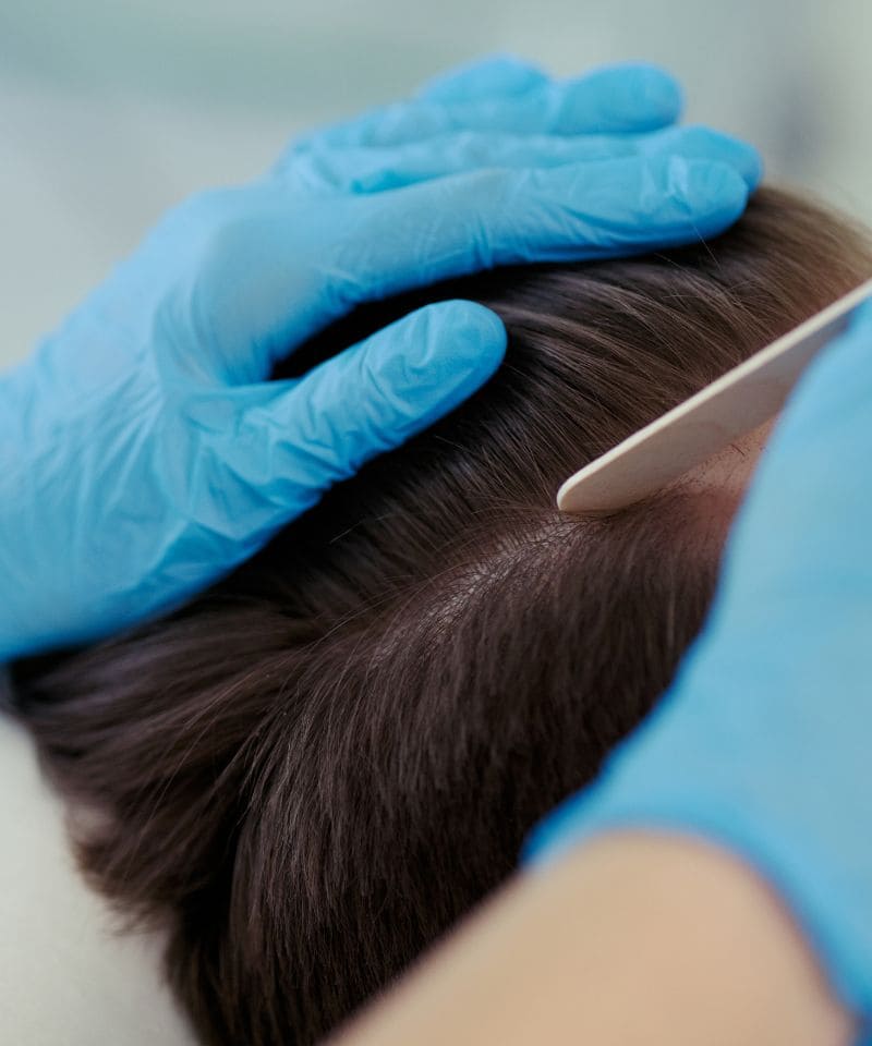 Especialista con guantes separando el pelo para revisar el cuero cabelludo